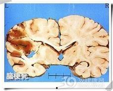 脑梗可以吃角瓜